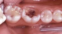 A periodontitis fotók, megelőzés, jelek, tünetek és kezelés