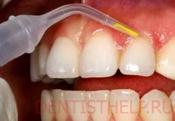 tratamentul si simptomele periodontita; fotografii gradul de parodontită; bolile gingivale tratate la Moscova