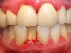 tratamentul si simptomele periodontita; fotografii gradul de parodontită; bolile gingivale tratate la Moscova