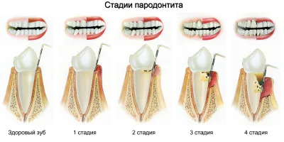 A periodontitis fotók, megelőzés, jelek, tünetek és kezelés