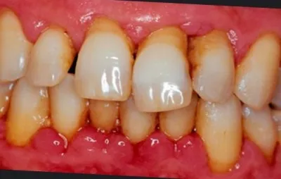 A periodontitis fotók, megelőzés, jelek, tünetek és kezelés