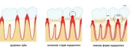 Cauzele parodontita, simptome, diagnostic și tratament