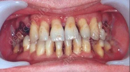 A periodontitis tünetei és paradentózisnál fotó