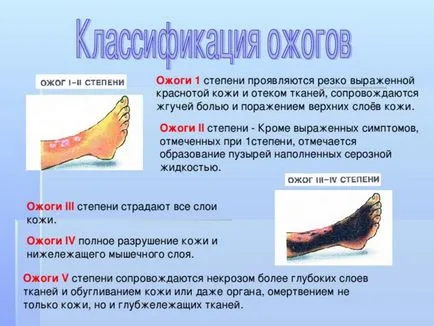 1 градус лечение на изгаряне в домашно видео околната среда