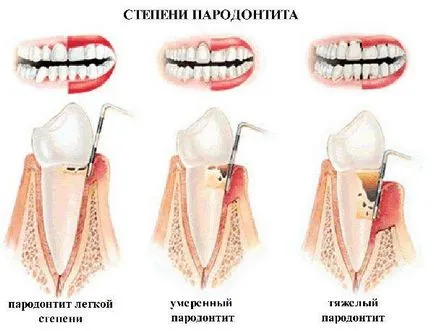 Cauzele parodontita, simptome, diagnostic și tratament