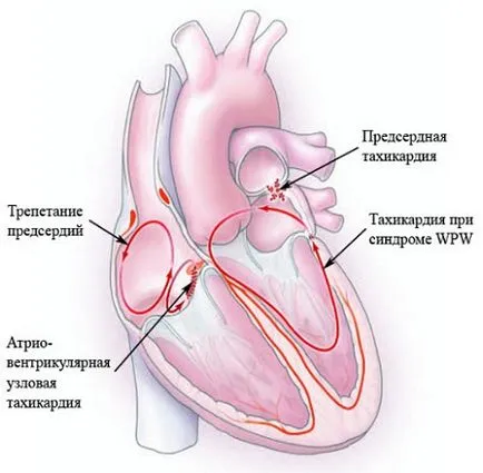Paroxizmális tachycardia a gyermekek a tünetek, a kezelés, megelőzés, a betegségek okait