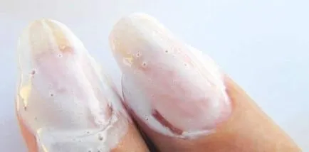 Водороден прекис оценки на нокти гъбички