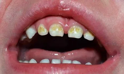 daca cariei se transmite prin sarut, în cazul în care cariilor dentare este contagioasă