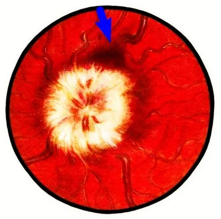 perimetru uterin