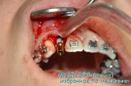 De ce dintii mai bine decât dezavantajele și efectele secundare ale implanturilor