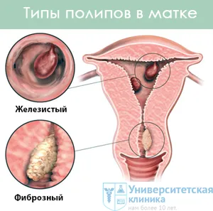 Полипите в утробата лечение на полипи в матката, отстраняване на полипите