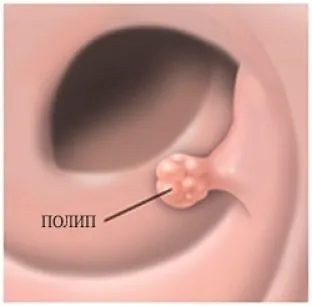 Polipok epehólyag - függetlenül attól, hogy veszélyes, és hogyan kell kezelni