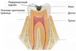 Повърхностни кариес - диагностика и лечение при деца и възрастни