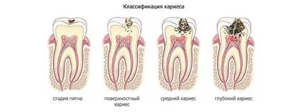 Повърхностни кариес - диагностика и лечение при деца и възрастни