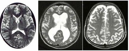 Creșterea presiunii intracraniene, creierul tratament hidrocefalie intern extern,