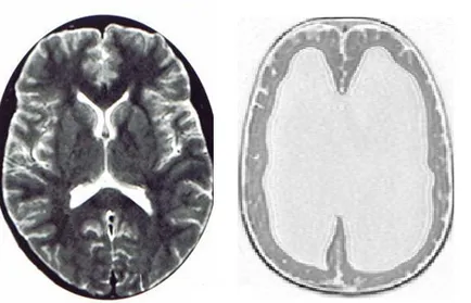 Fokozott intracranialis nyomás, a külső, belső agy hydrocephalus kezelése,