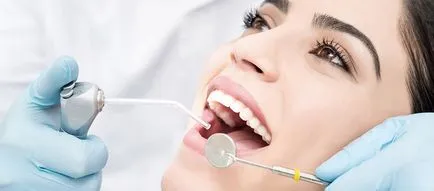 почистване при зъболекаря Професионални зъби