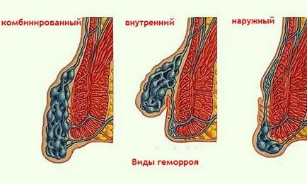 Психосоматиката хемороиди и психологически причини