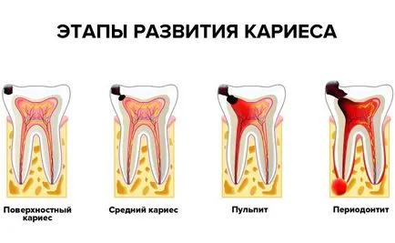 Pulpita la copii - diagnostic, tipuri, tratament