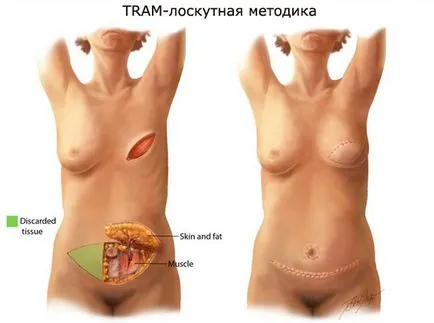 реконструкция на гърдата след мастектомия