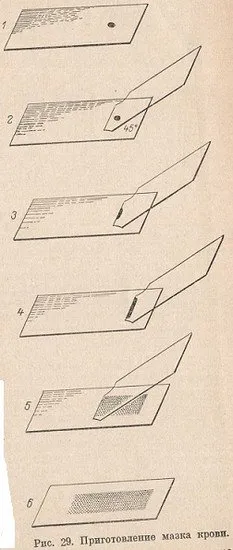 Előállítása vér kenet, vastag csepp, és a színük - a tanulmány a vér