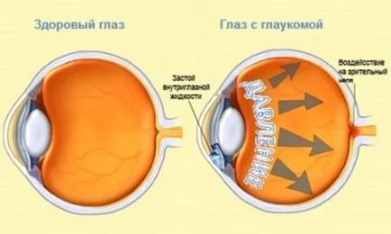 Prevenirea glaucom ca o modalitate de a păstra viziune
