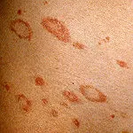 Pink Pecingine - Simptome de licheni roz - diagnostic și tratament al lichenul roz