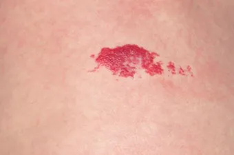 Birthmark inflamate si inflamat pentru un motiv oarecare, ce să facă