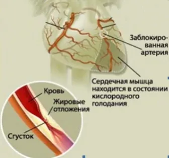 Инфаркт или инфаркт