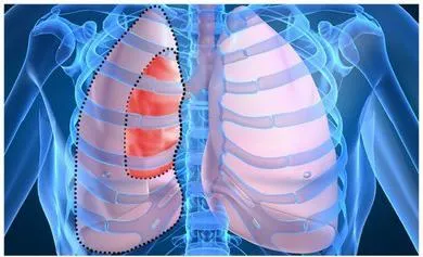 COPD-s tünetei klinika és a tünetek a felnőtt, a légzés és panaszok köhögés, láz