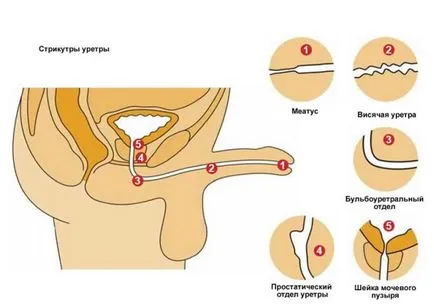 Húgycső szűkület a nők és a férfiak okok, tünetek, kezelés, a szövődmények