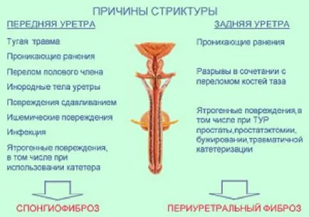 Уретрално структури при жените и на мъжете причини, симптоми, лечение, усложнения