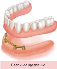 Протезиране върху импланти - протези