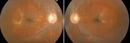 Tapetoretinalnoy abiotrophy ретината - причини, симптоми и лечение