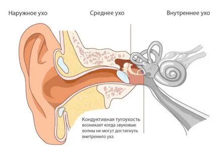 загуба на 1, 2, 3, 4 степени на симптомите и лечението на слуха