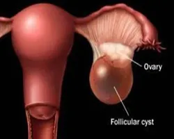 Узи follikulometriya за определен ден от цикъла, за да се направи