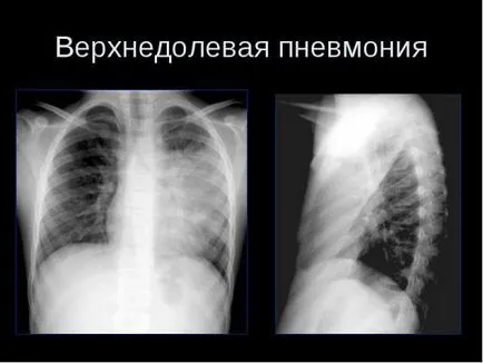 Verhnedolevaya tüdőgyulladás bal és jobb, vagy a tuberkulózis, a felső lebeny - tünetek és