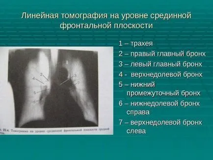 Verhnedolevaya tüdőgyulladás bal és jobb, vagy a tuberkulózis, a felső lebeny - tünetek és