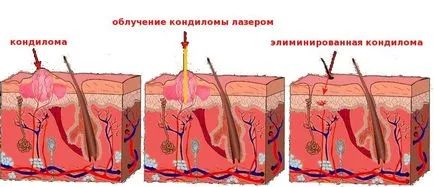 Вирусните брадавици лечение, симптоми, признаци на заболяване