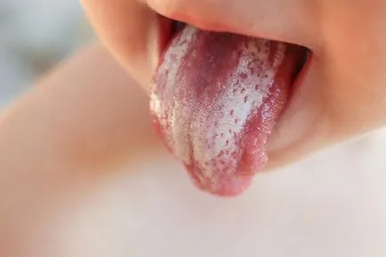 Възпаление на папилите на езика