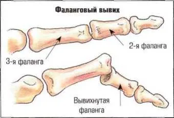 Rándulások és húzódások, stretching ínszalagok, ficamok oka