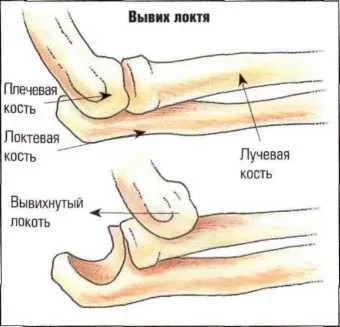 Luxațiilor și întinderilor musculare, ligamente stretching, entorsele motiv