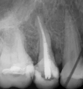 Relația dintre boala parodontală și patologia endodontic