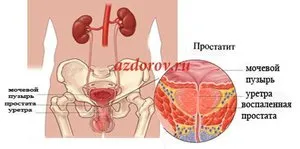 Хронични видове простатит и симптоми на симптомите на заболяването при мъжете, лечение