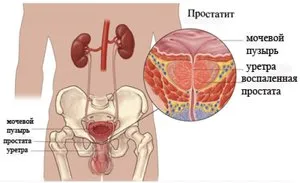 Tipuri de prostatita cronica si simptome ale simptomelor bolii la bărbați, tratament