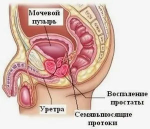 Хронични видове простатит и симптоми на симптомите на заболяването при мъжете, лечение