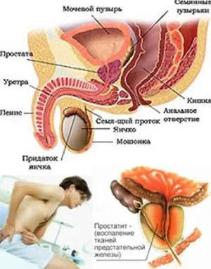 Krónikus prosztatagyulladás típusai és a betegség tünetei a férfiak tüneteinek kezelése