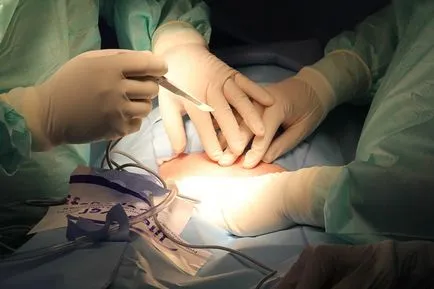 Хирургически видове конци за хирургически конци, заявление, обработка