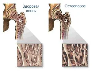 хип ставни заболявания при жените - основните видове