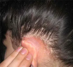 Fertőző hogy seborrhea a fejbőr lehet megszabadulni a betegség